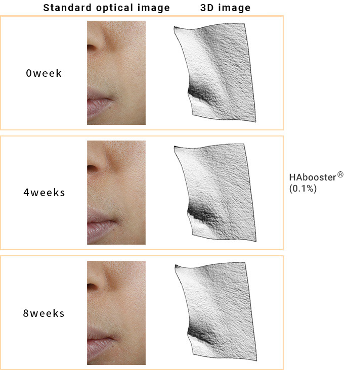 Improves skin wrinkle on the “nasolabial fold”